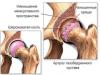 Лечение остеохондроза тазобедренного сустава, его симптомы и степени